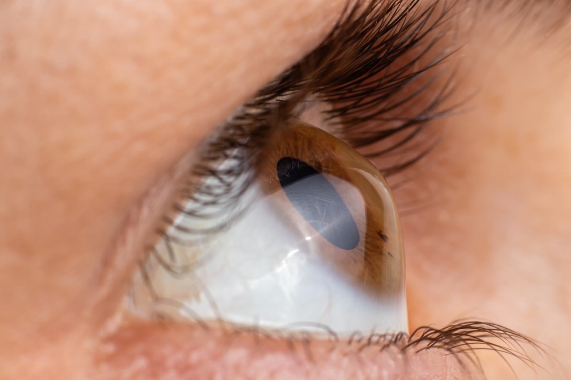 astigmatismo causato da errata curvatura della cornea
