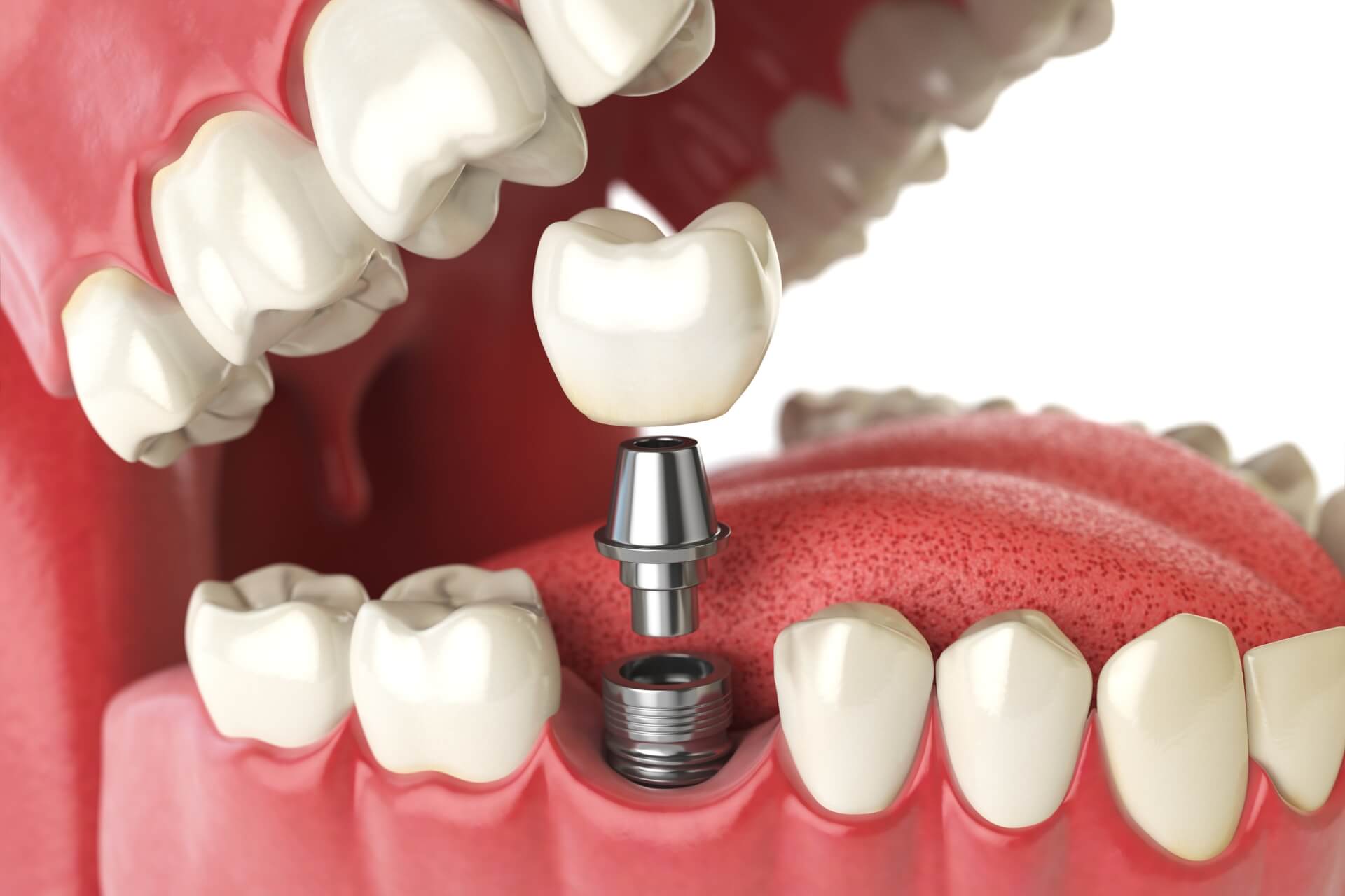 impianto-dentale-sostituzione-dente-mancante-chirurgia-implantare.jpg