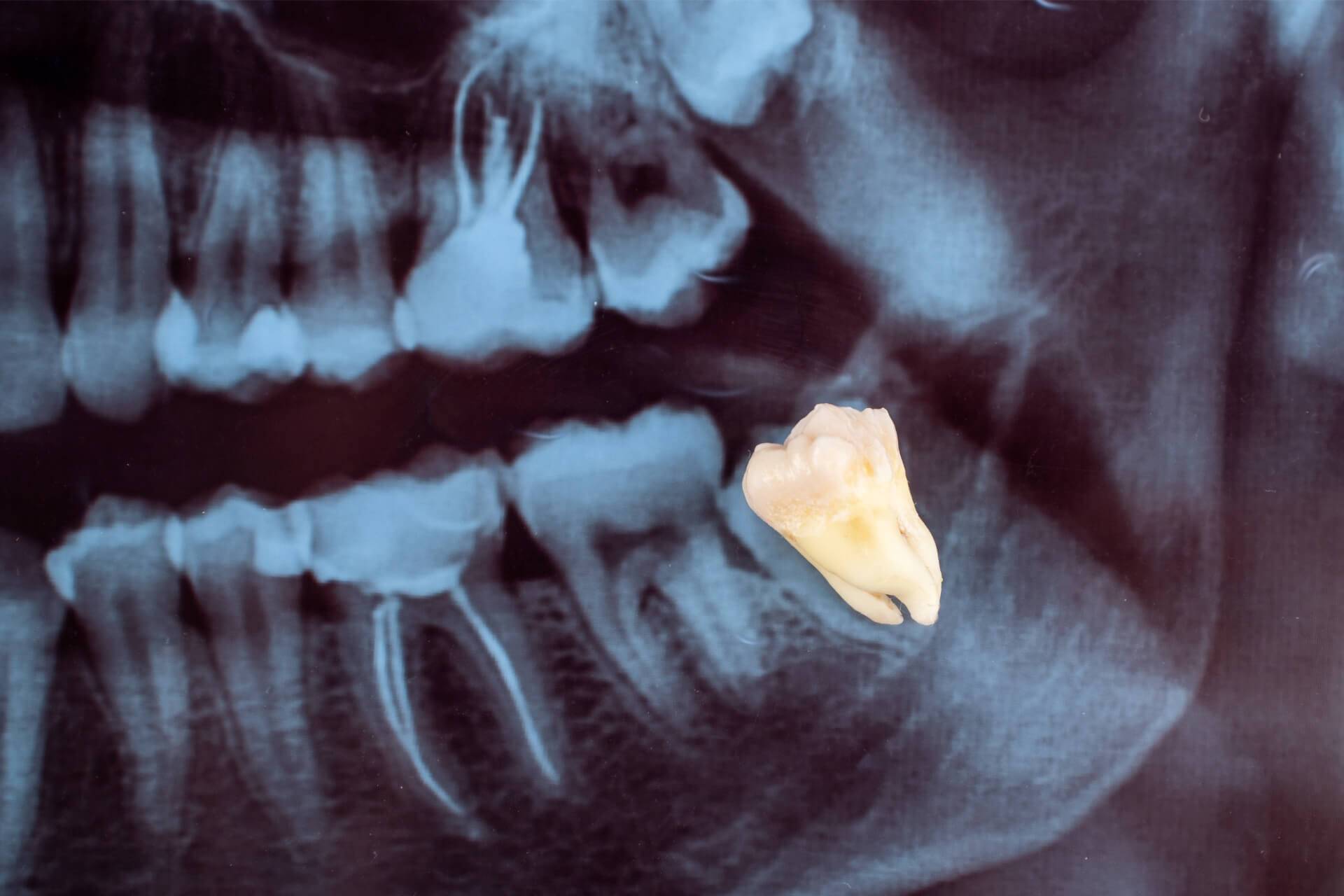 denti-giudizio-sintomi-estrazione-intervento-radiografia.jpg