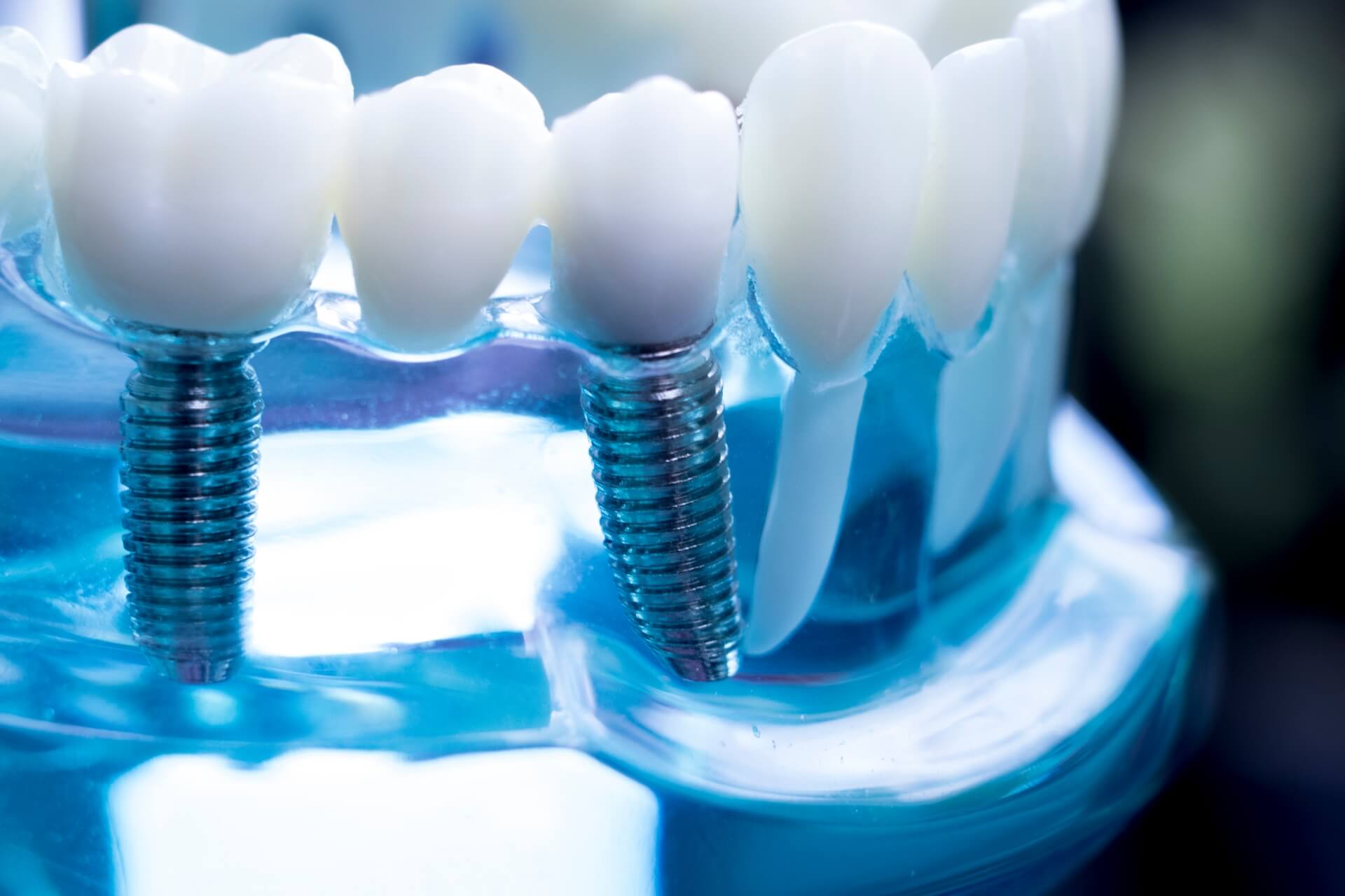 materiali, produttori e fornitori di impianti dentali in campo odontoiatrico e odontotecnico