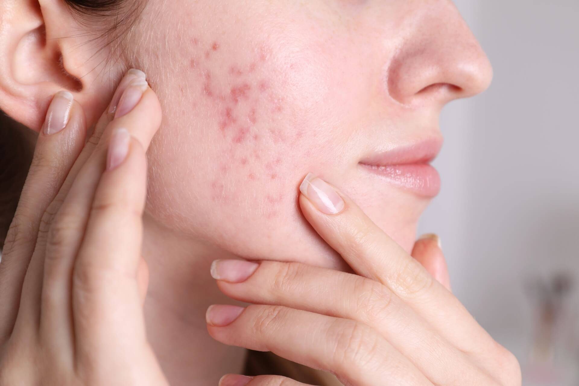 acne-adulti-pelle-viso-sintomi-cura-trattamento.jpg