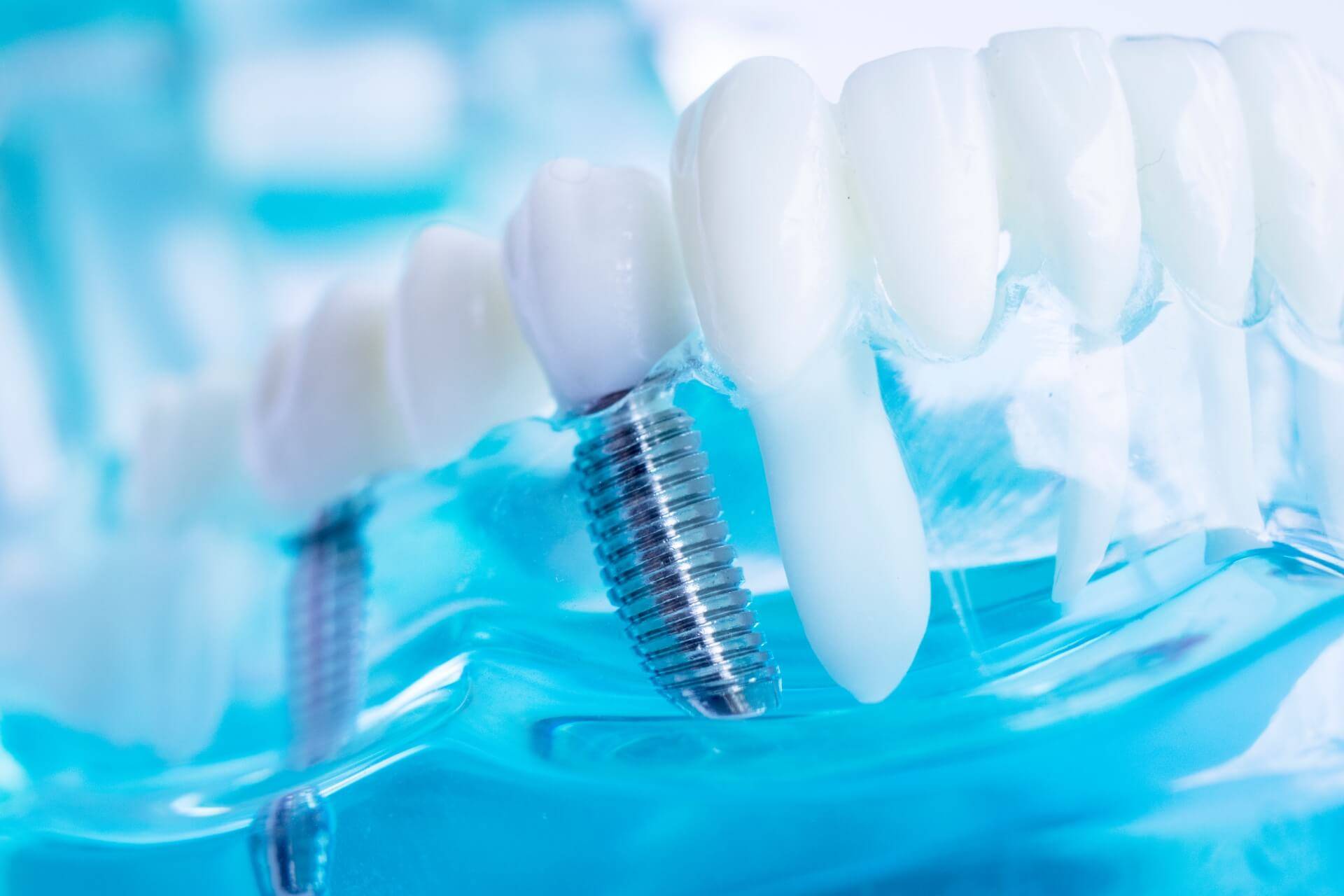 implantologia dentale: impianti carico immediato