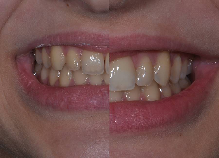 Odontoiatria restaurativa: correzione degli incisivi a Morbegno