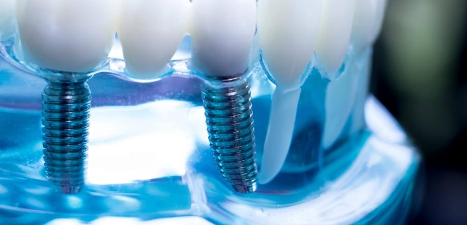 materiali, produttori e fornitori di impianti dentali in campo odontoiatrico e odontotecnico