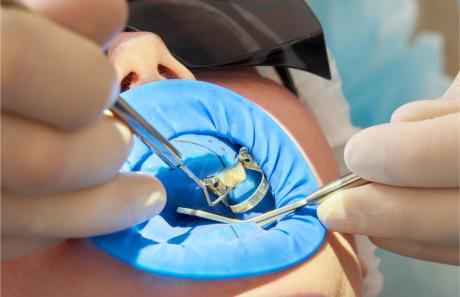 intervento odontoiatrico con diga dentale in lattice in studio dentistico