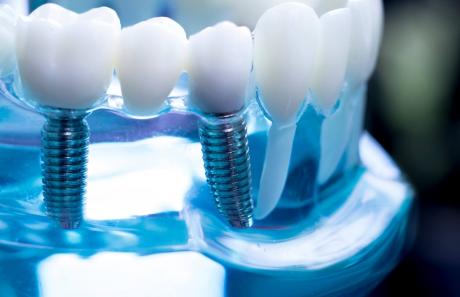 materiali, produttori e fornitori di impianti dentali in campo odontoiatrico e odontotecnico