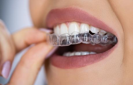 dentista che utilizza mascherine dentali trasparenti per riallineare i denti