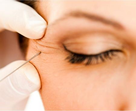 botox antiage per trattare le rughe