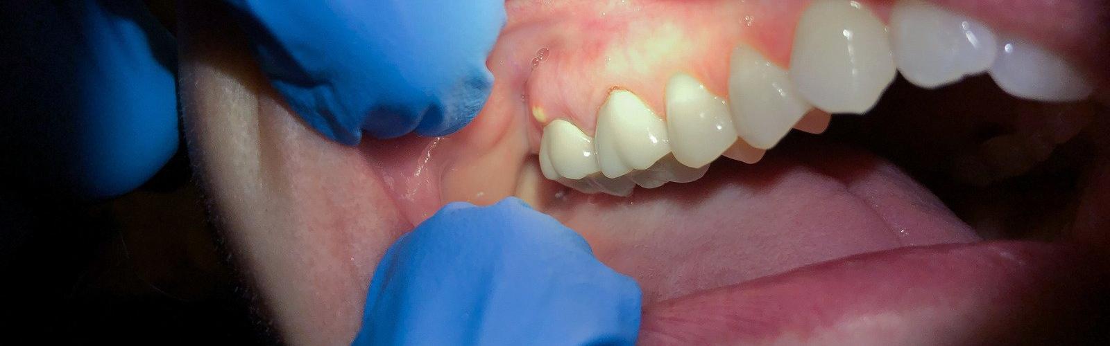 cura di un ascesso ai denti